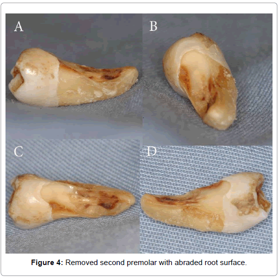 oral-hygiene-health-removed-second-premolar