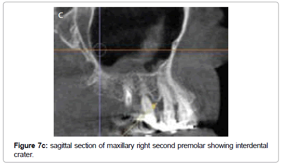 oral-hygiene-health-sagittal-maxillary-premolar