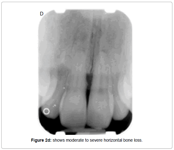 oral-hygiene-health-shows-moderate-severe