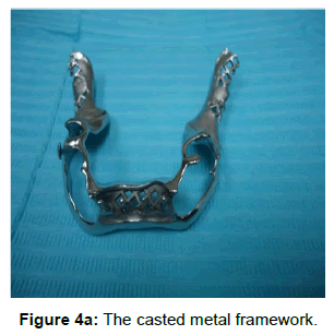 oral-hygiene-health-the-casted-framework