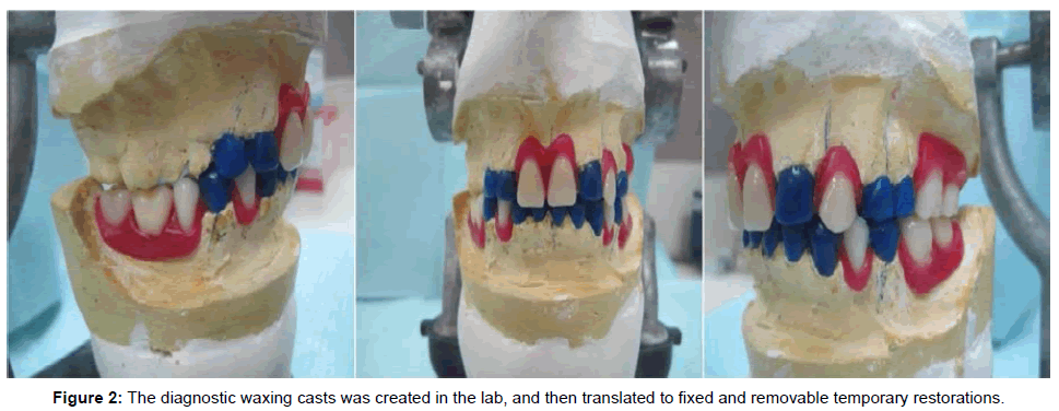 oral-hygiene-health-the-diagnostic-waxing