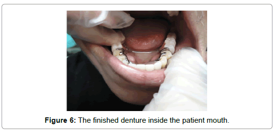 oral-hygiene-health-the-finished-denture