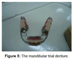 oral-hygiene-health-the-mandibular-trial