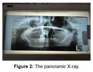 oral-hygiene-health-the-panoramic-x-ray
