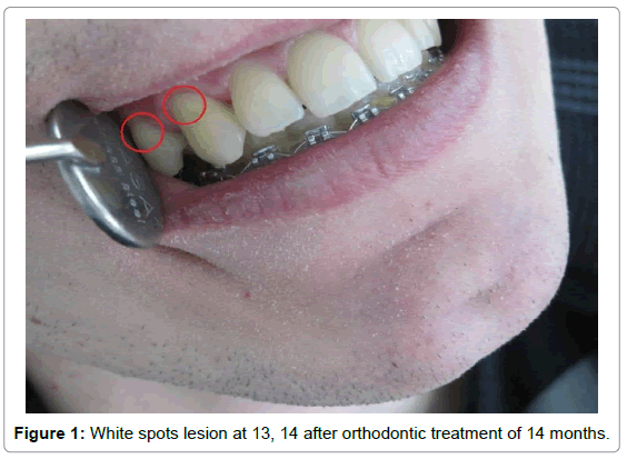 oral-hygiene-health-white-spots-lesion