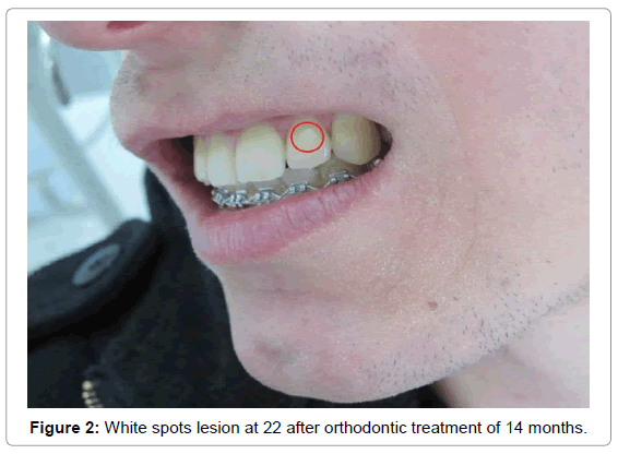 oral-hygiene-health-white-spots-lesion