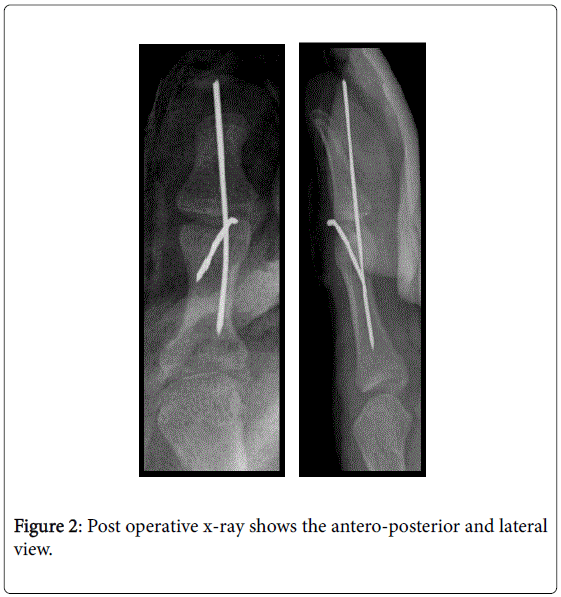 The Ishiguro Technique for the Treatment of Adolescent Mallet Thumb
