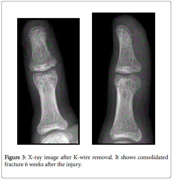 The Ishiguro Technique for the Treatment of Adolescent Mallet Thumb Fracture OMICS International