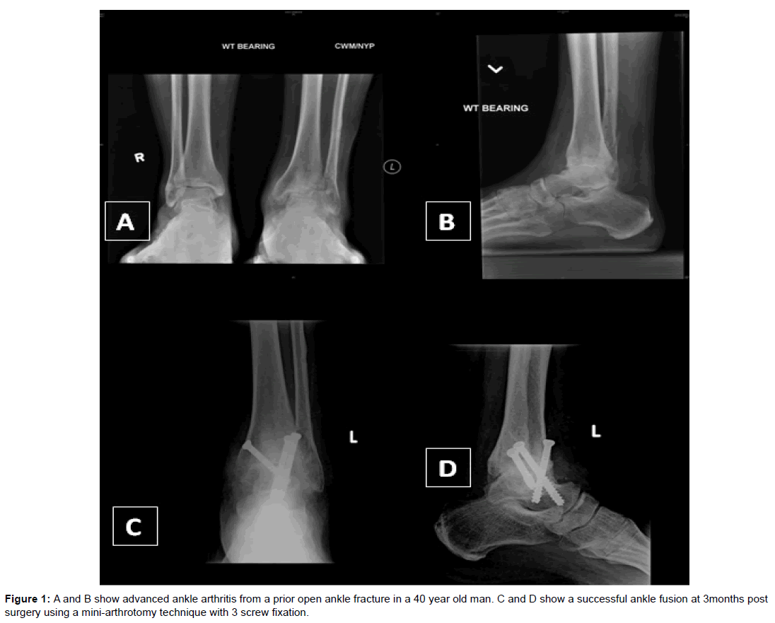 Артродез голеностопного сустава форум отзывы. Трехсуставной артродез. Внесуставной артродез. Артродез голеностопного сустава аппаратом илизарова. Костный артродез голеностопного сустава.