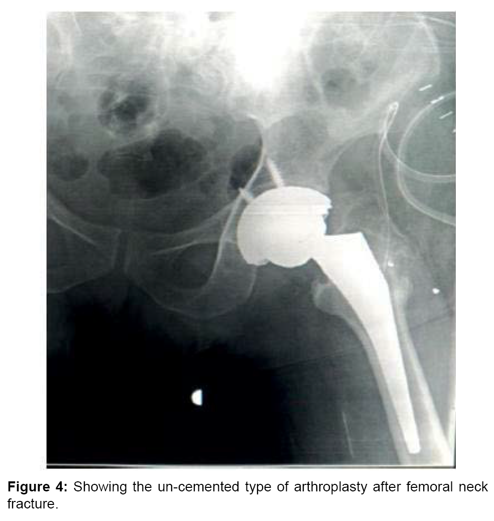 Fracture of the femoral neck in old age is a verdict Fracture of the femoral neck in old age is a verdict