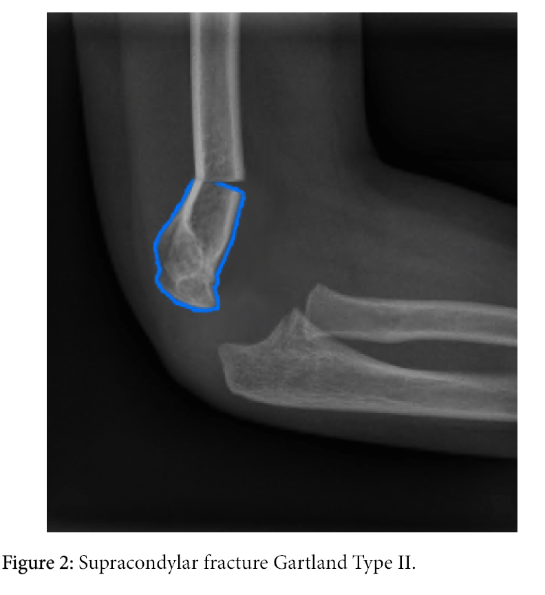 supracondylar fracture humerus supracondylar fracture humerus