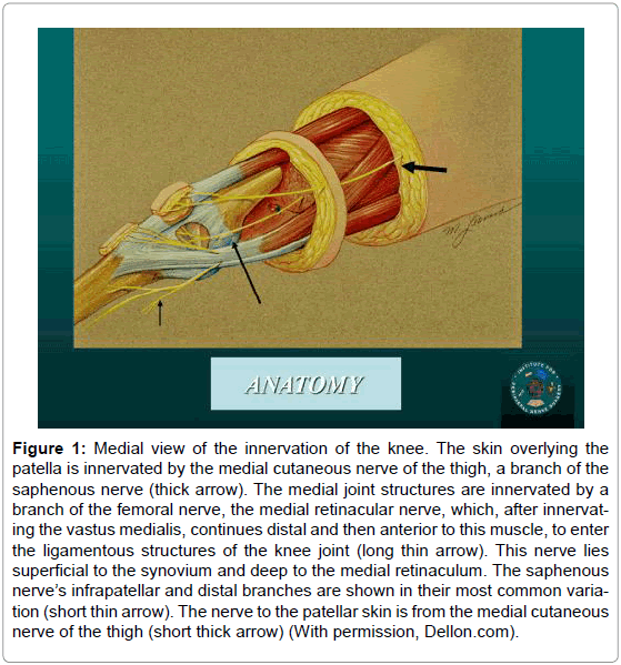 Partial Knee Joint Denervation for Knee Pain A Review OMICS International