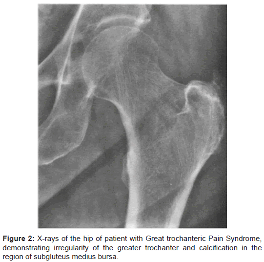 Trochanteritis x ray
