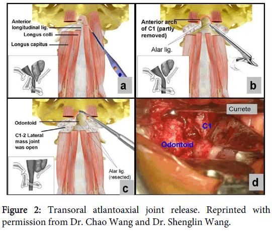 atlantoaxial joint