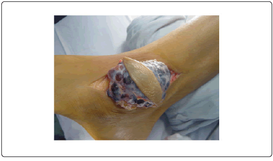 orthopedic-oncology