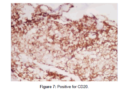 orthopedic-oncology-CD20