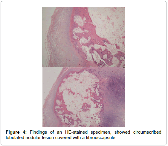 orthopedic-oncology-Findings-HE-stained-specimen