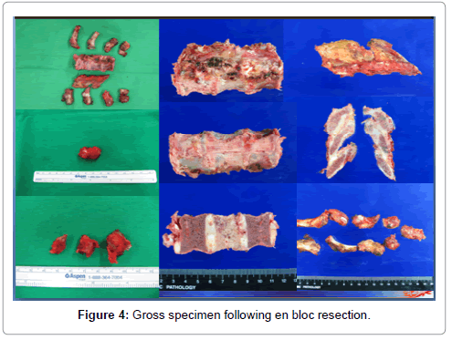 orthopedic-oncology-Gross-specimen-en-bloc-resection