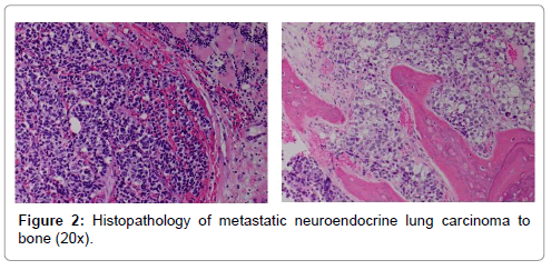 orthopedic-oncology-Histopathology-metastatic-neuroendocrine-lung