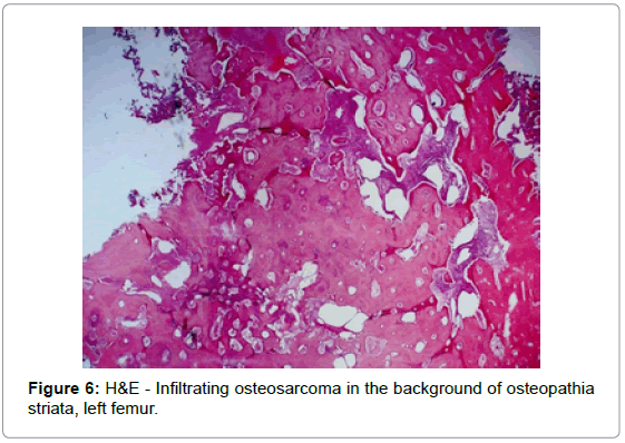 orthopedic-oncology-Infiltrating-osteosarcoma-background-osteopathia