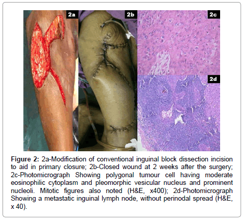 orthopedic-oncology-Modification-conventional-inguinal-block