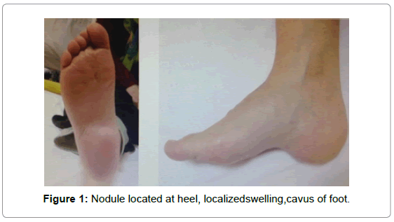 orthopedic-oncology-Nodule-located-heel-localizedswelling