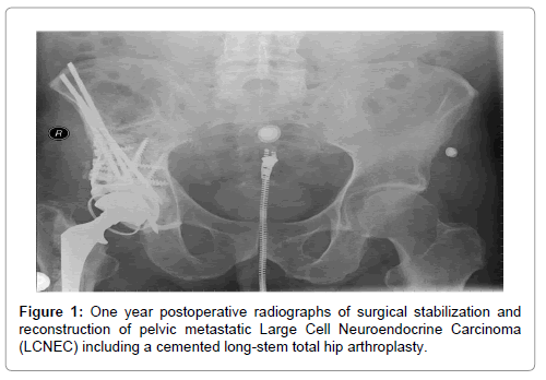 orthopedic-oncology-One-year-postoperative-radiographs