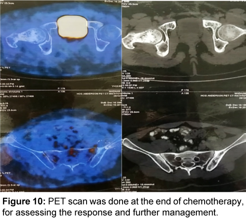 orthopedic-oncology-PET-scan