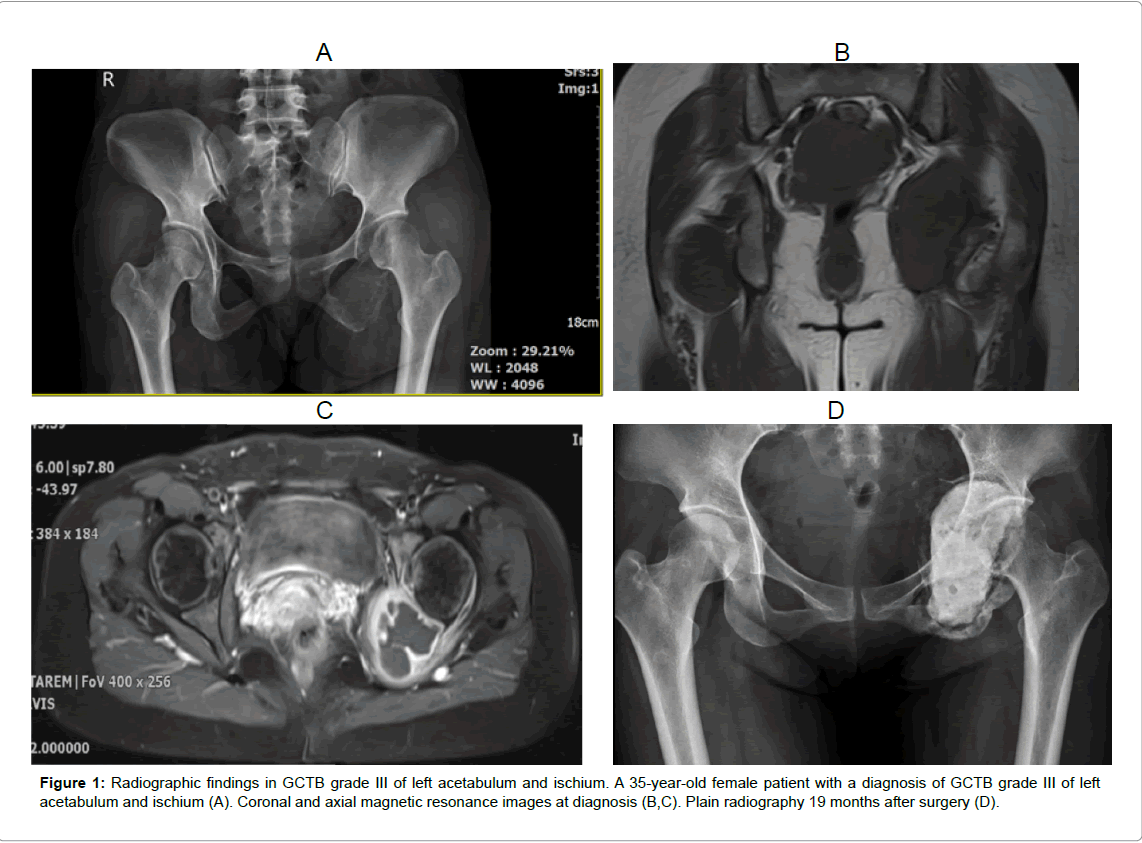 orthopedic-oncology-Radiographic-findings