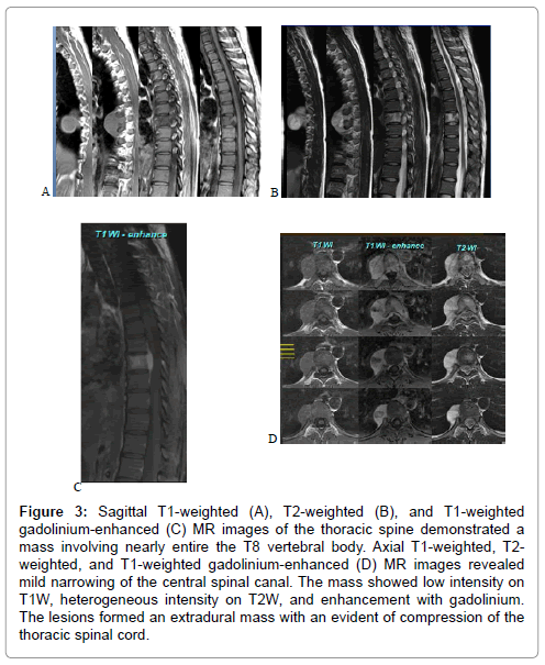 orthopedic-oncology-Sagittal-T1-weighted-T2-weighted