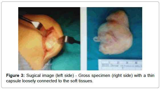 orthopedic-oncology-Sugical-image-Gross-specimen