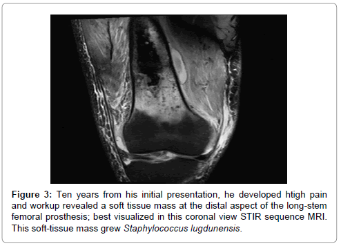 orthopedic-oncology-Ten-years-his-initial-presentation