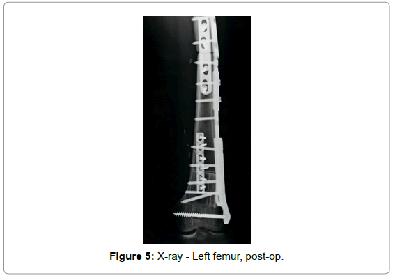 orthopedic-oncology-X-ray-Left-femur