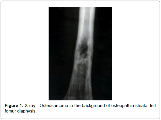 orthopedic-oncology-X-ray-Osteosarcoma-background-osteopathia