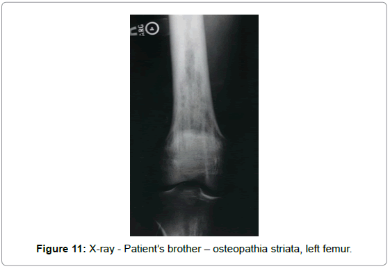 orthopedic-oncology-X-ray-Patient-brother