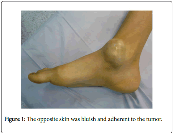 orthopedic-oncology-bluish-adherent