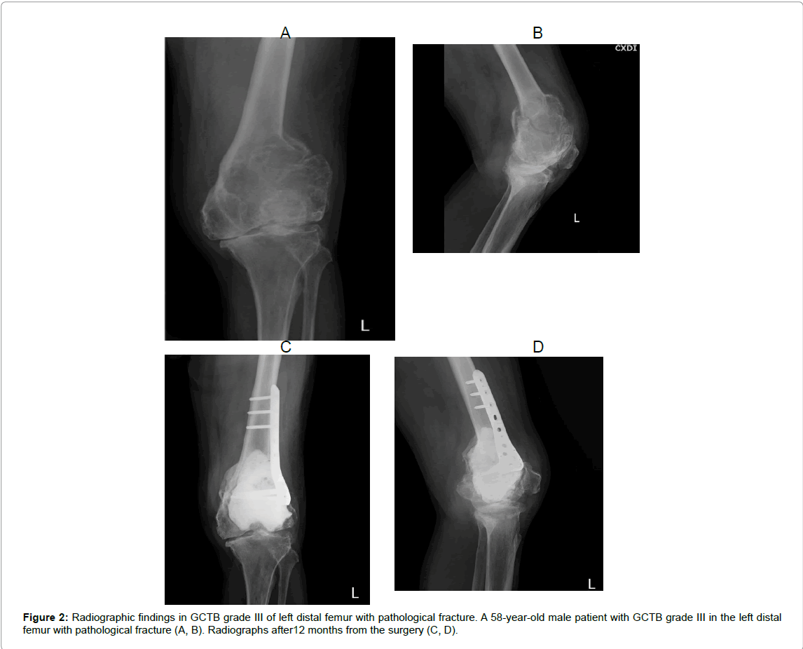 orthopedic-oncology-distal-femur