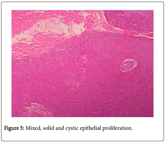 orthopedic-oncology-epithelial-proliferation