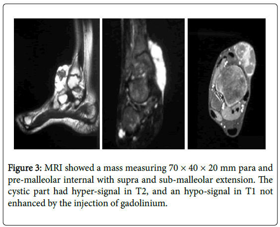 orthopedic-oncology-mass-measuring