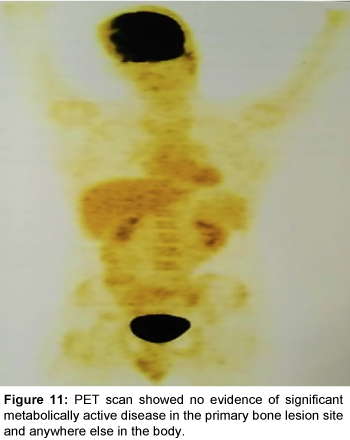 orthopedic-oncology-metabolically