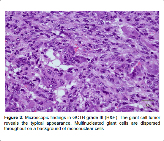 orthopedic-oncology-mononuclear-cells