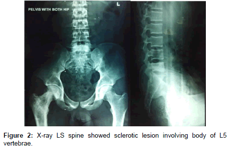 orthopedic-oncology-sclerotic-lesion