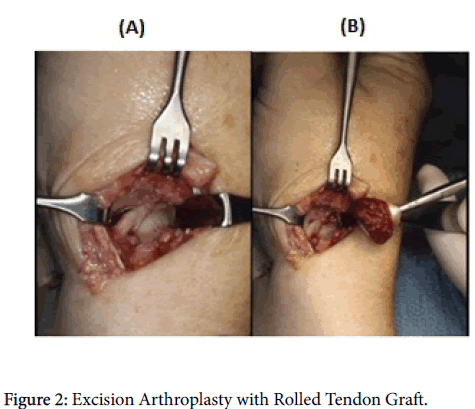 osteoarthritis-Arthroplasty-Rolled-Tendon-Graft