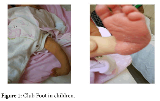 osteoarthritis-Club-Foot-children
