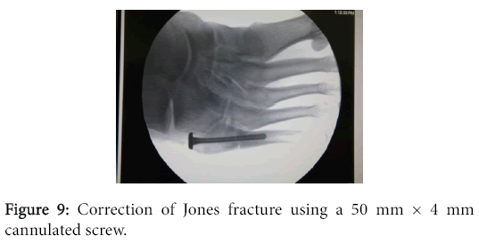 osteoarthritis-Correction-Jones-fracture