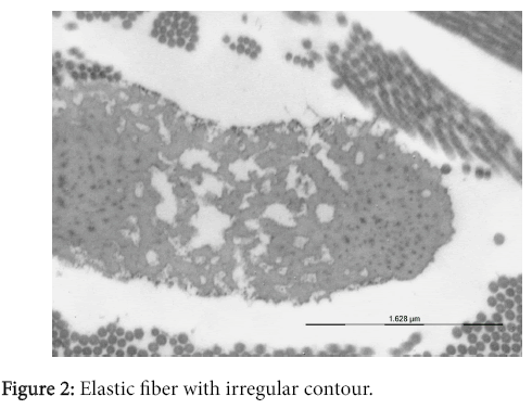 osteoarthritis-Elastic-fiber-irregular-contour