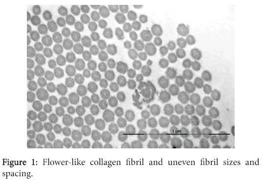 osteoarthritis-Flower-like-collagen-fibril