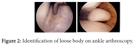 osteoarthritis-Identification-loose-body-ankle-arthroscopy