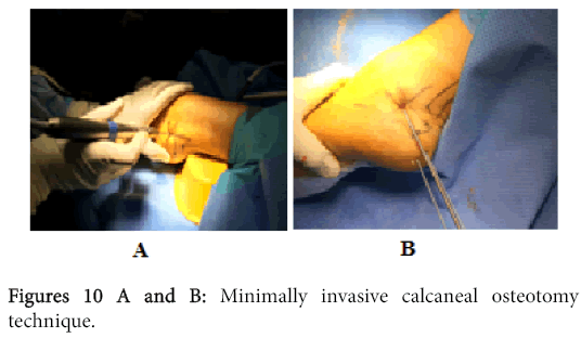 osteoarthritis-Minimally-invasive-calcaneal-osteotomy