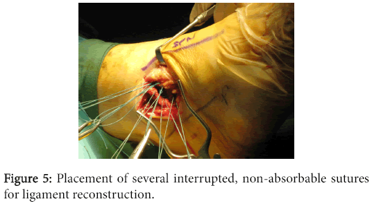 osteoarthritis-Placement-several-interrupted-non-absorbable-sutures